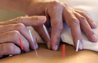 Acupuntura Auricular e Drenagem Linfática Iraci - Foto 1